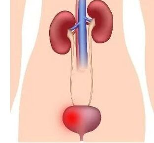 Reasons for developing cystitis in women