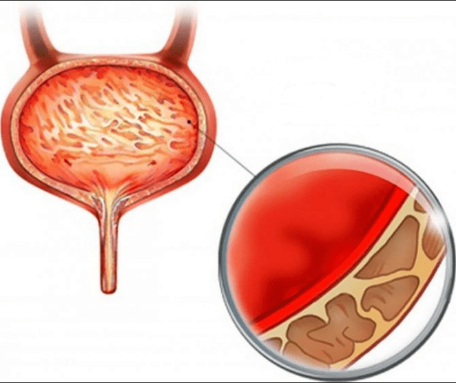 Inflammation of the cystitis