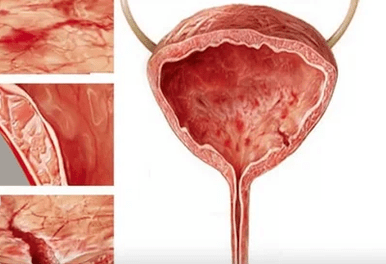 Reasons for developing cystitis in women